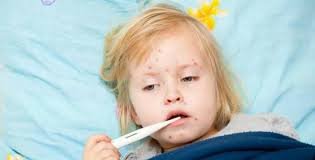  الحصبة تتخطى 700 إصابة في 6 ولايات أميركية