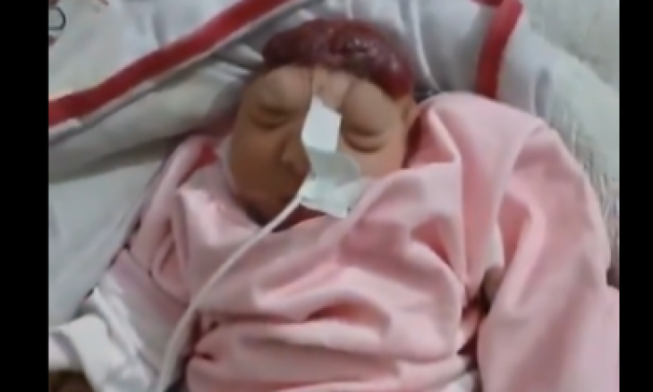 الطفلة ملك القانوع ولدت  "بلا دماغ"  في قطاع غزة