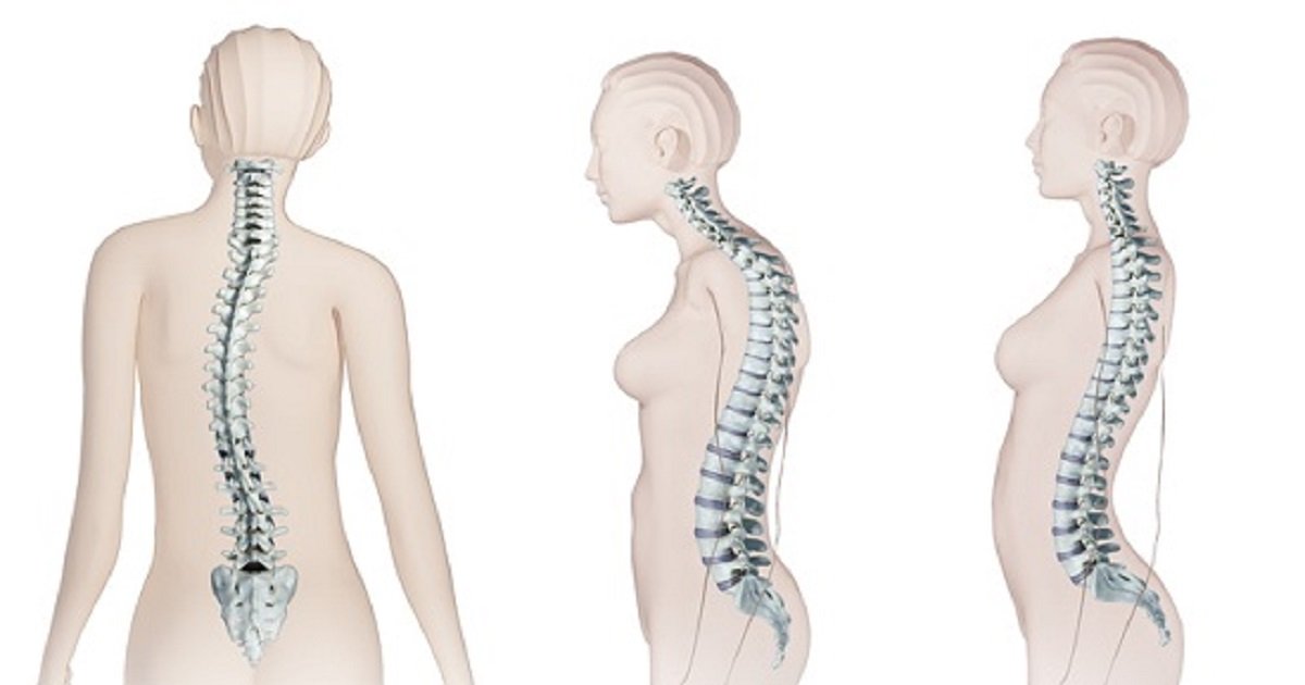 الجنف.. انحناء العمود الفقري بين عوامل وراثية وأمل العلاج المبكر