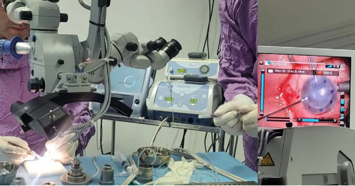 زراعة قرنية بتقنية مبتكرة