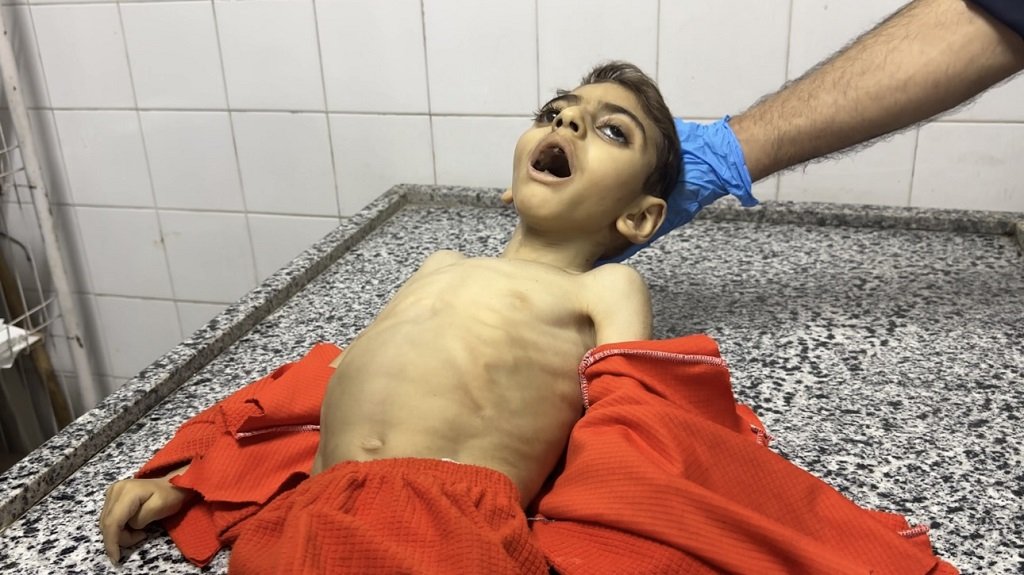   300 وفاة في غزة منذ مارس بسبب نقص الغذاء والدواء وسوء التغذية